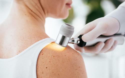 Melanóma tünetei és szűrése - Időben felismerve életet menthet